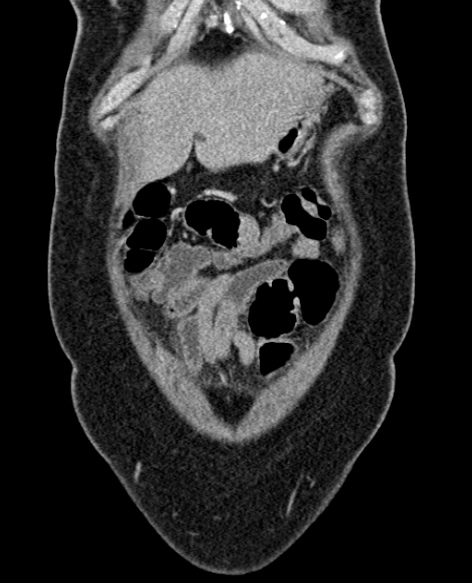 File:Acute appendicitis (Radiopaedia 48792-53822 Coronal C+ portal venous phase 47).jpg