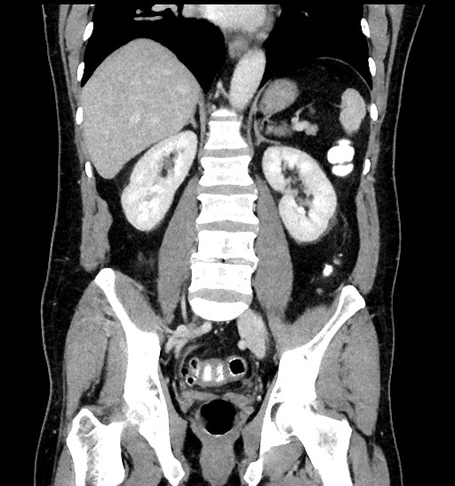 Acute appendicitis (Radiopaedia 77016-88960 Coronal C+ portal venous phase 63).jpg