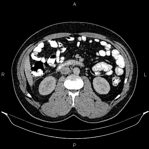 Acute appendicitis (Radiopaedia 84780-100240 Axial C+ portal venous phase 48).jpg
