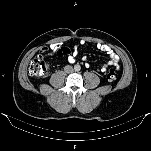 File:Acute appendicitis (Radiopaedia 84780-100240 Axial C+ portal venous phase 64).jpg