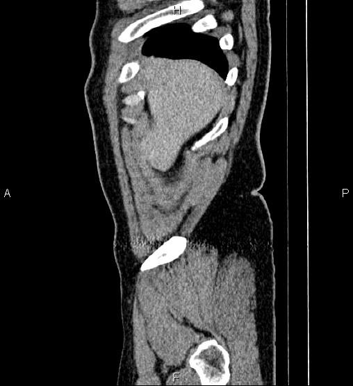 Acute appendicitis (Radiopaedia 84780-100240 Sagittal C+ portal venous phase 6).jpg