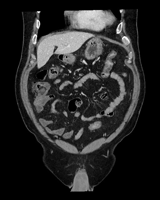 Acute appendicitis - large appendicoliths (Radiopaedia 61805-69820 Coronal C+ portal venous phase 38).jpg