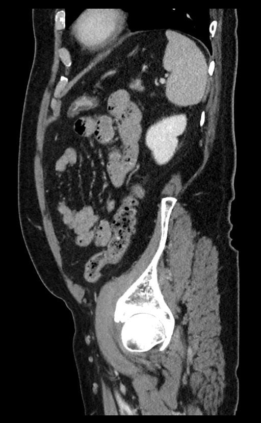 Acute appendicitis - large appendicoliths (Radiopaedia 61805-69820 Sagittal C+ portal venous phase 27).jpg