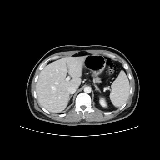 File:Acute appendicitis and COVID 19 pneumonia (Radiopaedia 76604-88380 Axial C+ portal venous phase 20).jpg
