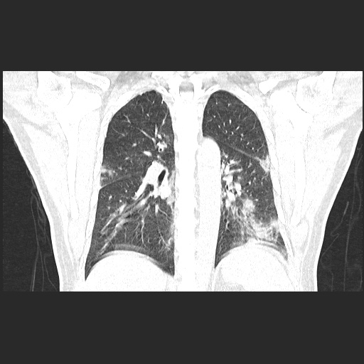 Acute appendicitis and COVID 19 pneumonia (Radiopaedia 76604-88380 G 42).jpg