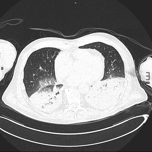 Acute aspiration pneumonitis (Radiopaedia 55642-62166 Axial lung window 103).jpg