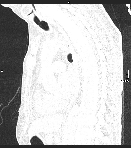 Acute aspiration pneumonitis (Radiopaedia 55642-62166 Sagittal lung window 72).jpg
