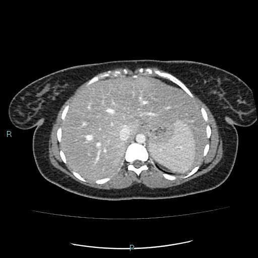 Acute bilateral pyelonephritis (Radiopaedia 37146-38881 Axial C+ portal venous phase 16).jpg