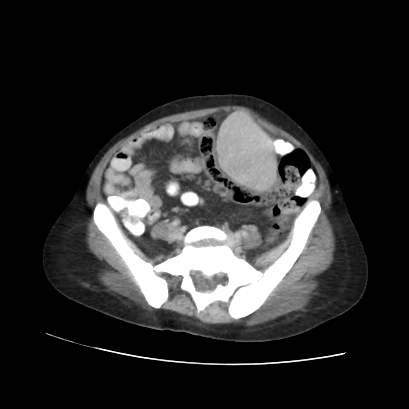 Acute calculous cholecystitis in patient with osteopetrosis (Radiopaedia 77871-90159 Axial C+ portal venous phase 59).jpg