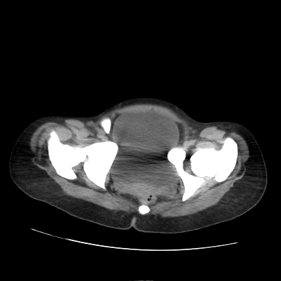 File:Acute calculous cholecystitis in patient with osteopetrosis (Radiopaedia 77871-90159 Axial non-contrast 75).jpg