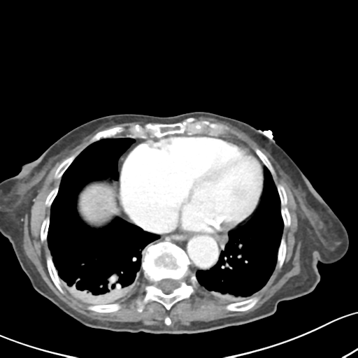 File:Acute cholecystitis with contained perforation (Radiopaedia 47328-51907 Axial C+ portal venous phase 3).png