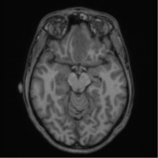 Acute disseminated encephalomyelitis (ADEM) (Radiopaedia 65319-74349 Axial T1 24).png