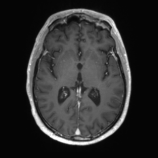 Acute disseminated encephalomyelitis (ADEM) (Radiopaedia 65319-74350 Axial T1 C+ 30).png