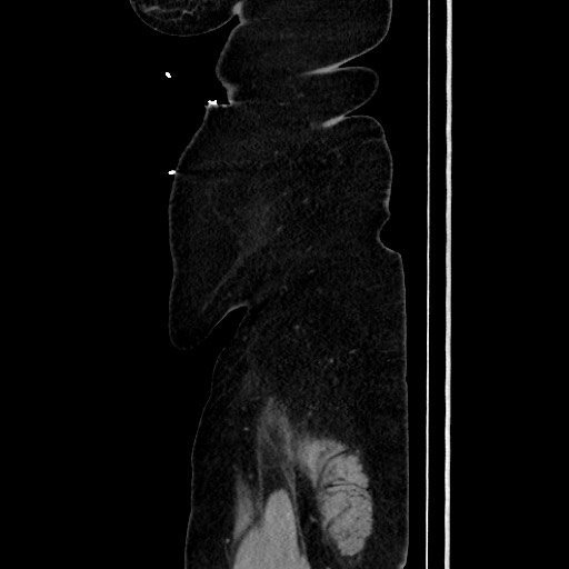 Acute diverticulitis - transverse colon (Radiopaedia 87063-103327 Sagittal C+ portal venous phase 207).jpg