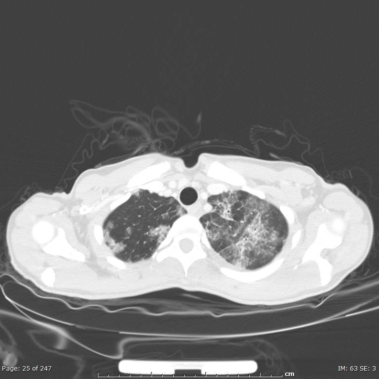 Acute eosinophilic pneumonia (Radiopaedia 48211-53073 Axial lung window 9).jpg