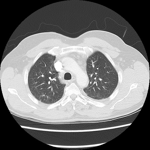 File:Acute epicardial fat necrosis (Radiopaedia 42327-45440 Axial lung window 21).jpg
