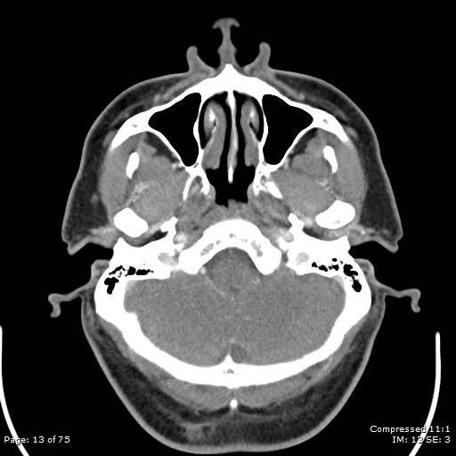 Acute epiglottitis (Radiopaedia 54375-60590 Axial C+ arterial phase 13).jpg