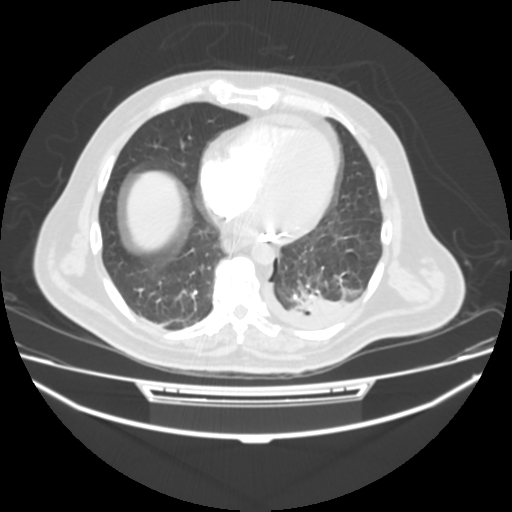 File:Acute heart failure (CT) (Radiopaedia 79835-93075 Axial lung window 33).png