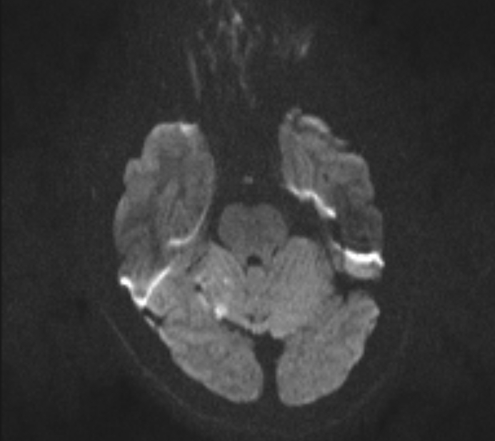 Acute ischemic stroke - posterior circulation territory (Radiopaedia 77670-89880 Axial DWI 54).jpg