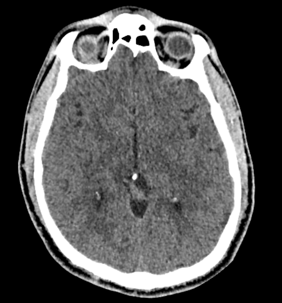 Acute ischemic stroke - posterior circulation territory (Radiopaedia 77670-89881 non-contrast 42).jpg