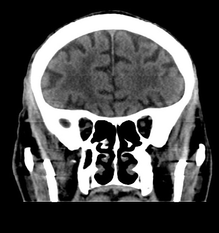 File:Acute left anterior cerebral artery territory infarction (Radiopaedia 51785-57578 Coronal non-contrast 17).jpg
