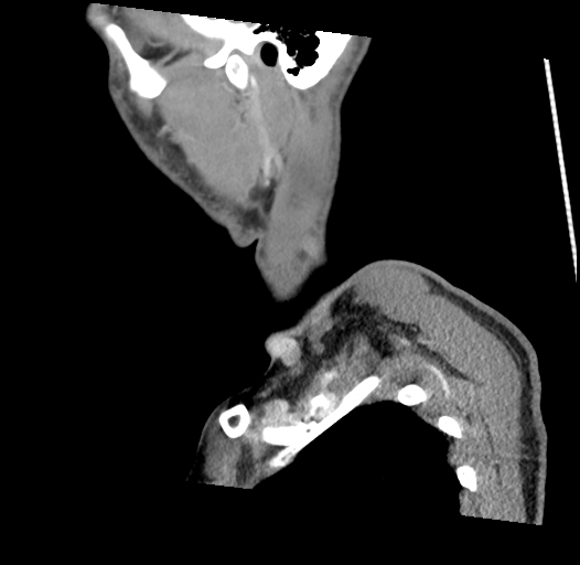 Acute longus colli calcific tendinitis (Radiopaedia 72495-83036 Sagittal C+ arterial phase 60).jpg
