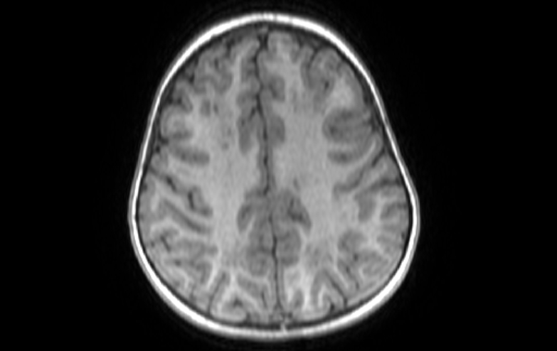 Acute necrotizing encephalitis of childhood (Radiopaedia 67356-76737 Axial T1 26).jpg