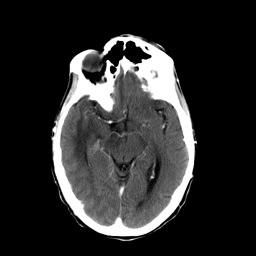 File:Acute necrotizing toxoplasma encephalitis (Radiopaedia 10683-11150 C+ arterial phase 19).jpg
