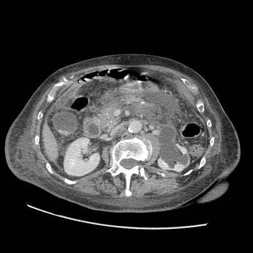 File:Acute on chronic pancreatitis (Radiopaedia 13233-13244 Axial C+ portal venous phase 44).jpg