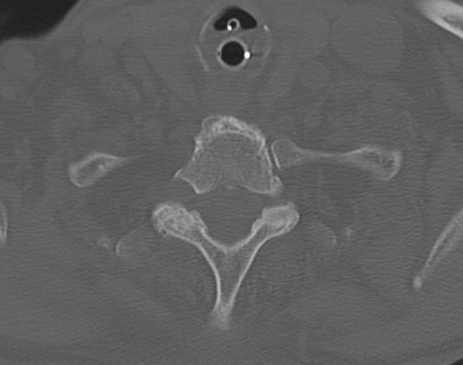 Acute on chronic subdural hematoma and thoracic vertebral injury in a multitrauma patient (Radiopaedia 31698-32619 Axial bone window 52).jpg