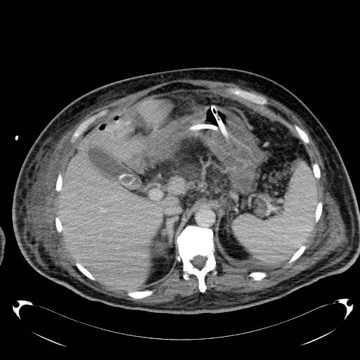 Acute pancreatic necrosis (Radiopaedia 13560-18503 Axial C+ portal venous phase 19).jpg