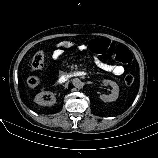 Acute pancreatitis (Radiopaedia 85146-100701 Axial non-contrast 56).jpg