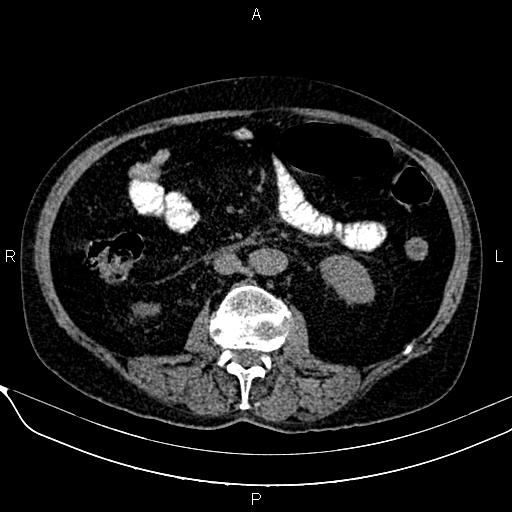 Acute pancreatitis (Radiopaedia 85146-100701 Axial non-contrast 64).jpg