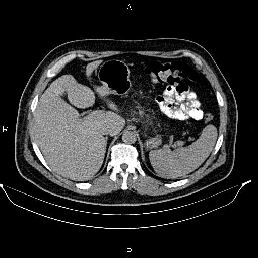 File:Acute pancreatitis (Radiopaedia 85390-101010 Axial C+ delayed 14).jpg