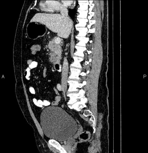 Acute pancreatitis (Radiopaedia 85390-101010 Sagittal C+ portal venous phase 46).jpg