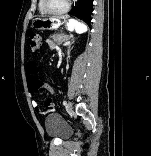 File:Acute pancreatitis (Radiopaedia 85390-101010 Sagittal C+ portal venous phase 64).jpg