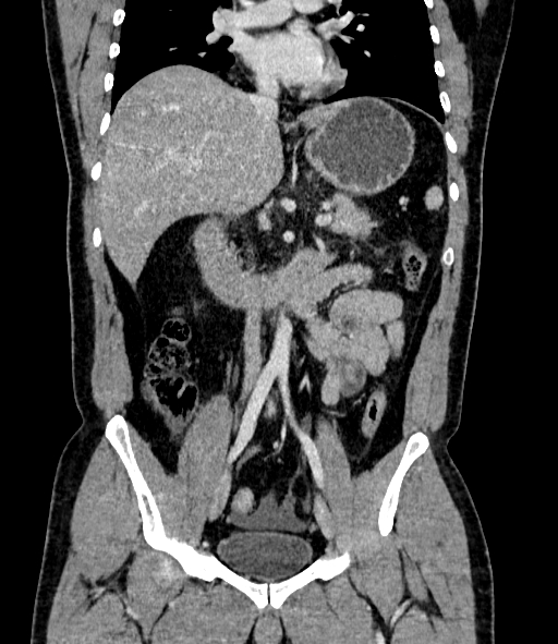 File:Acute pancreatitis (Radiopaedia 87428-103757 Coronal C+ portal venous phase 47).jpg