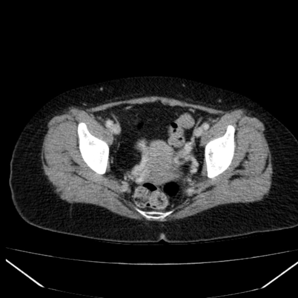 Acute pancreatitis - Balthazar C (Radiopaedia 26569-26714 Axial C+ portal venous phase 85).jpg