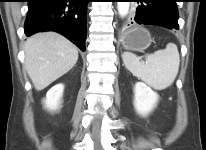File:Acute pancreatitis and walled-off necrosis (Radiopaedia 29888-30404 Coronal C+ portal venous phase 40).jpg