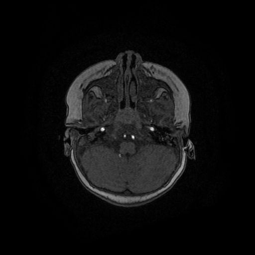 Acute phase of hemiconvulsion-hemiplegia epilepsy syndrome (Radiopaedia 29309-29745 Axial TOF angiography 128).jpg