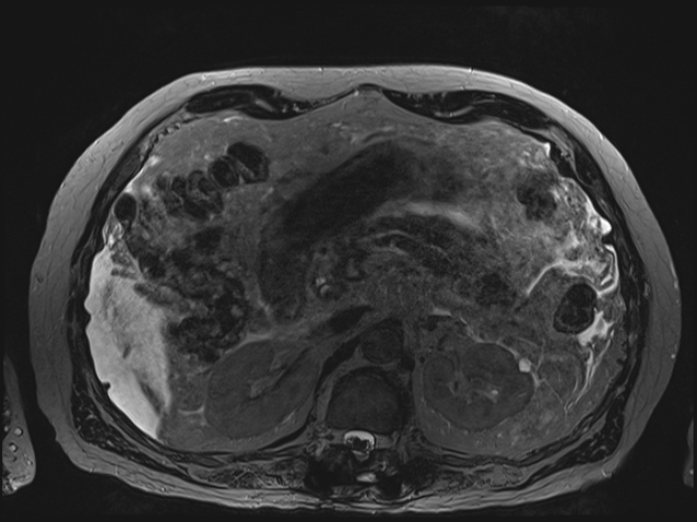 Acute portal vein thrombosis (Radiopaedia 73198-83925 Axial Heavily T2 thin cuts 39).jpg
