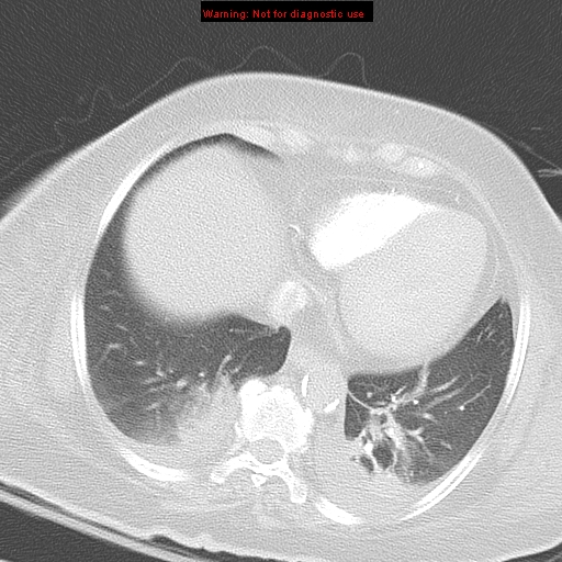 File:Acute pulmonary embolism (Radiopaedia 13286-13289 B 30).jpg