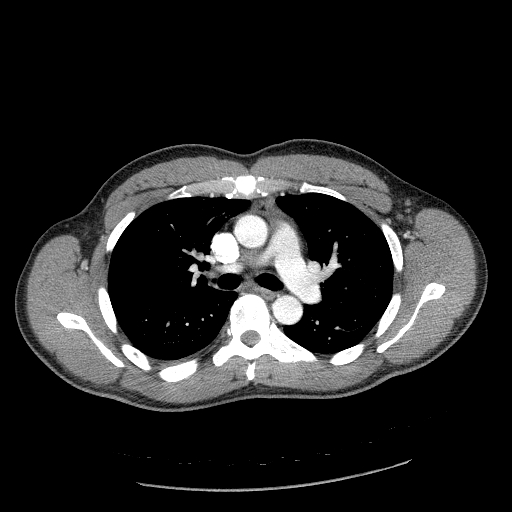 Acute segmental pulmonary emboli and pulmonary infarction (Radiopaedia 62264-70444 Axial C+ CTPA 47).jpg