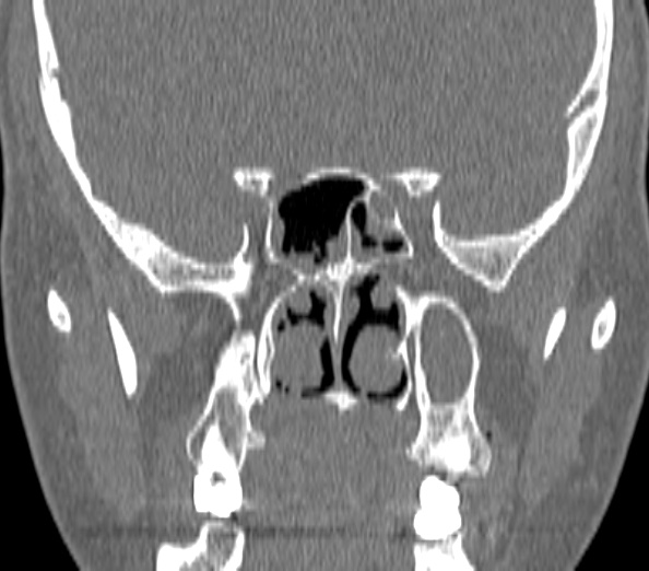 Acute sinusitis (Radiopaedia 40564-43158 Coronal bone window 32).jpg