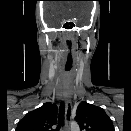 File:Acute submandibular sialadenitis secondary to ductal stone (Radiopaedia 27999-28267 D 31).jpg