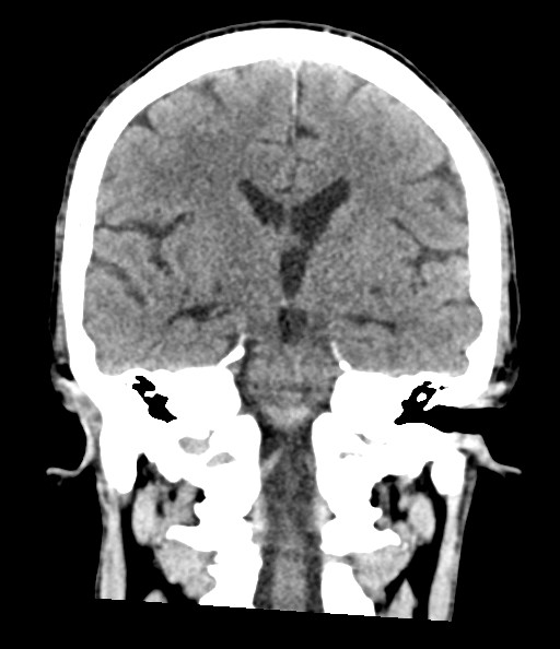 Acute superior cerebellar artery territory infarct (Radiopaedia 84104-99359 Coronal non-contrast 51).jpg