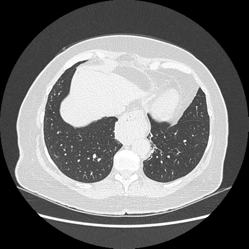 Adenocarcinoma in situ of lung (Radiopaedia 38685-40829 B 174).png