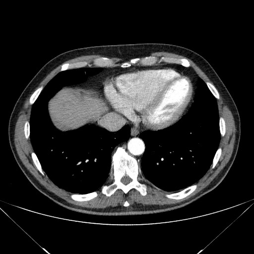 File:Adenocarcinoma of the lung (Radiopaedia 59871-67325 Axial C+ arterial phase 72).jpg