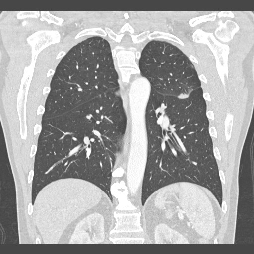 Adenocarcinoma of the lung (Radiopaedia 59871-67325 Coronal lung window 41).jpg