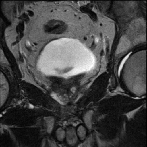 File:Adenocarcioma of rectum- T1 lesion (Radiopaedia 36921-38546 Coronal T2 20).png